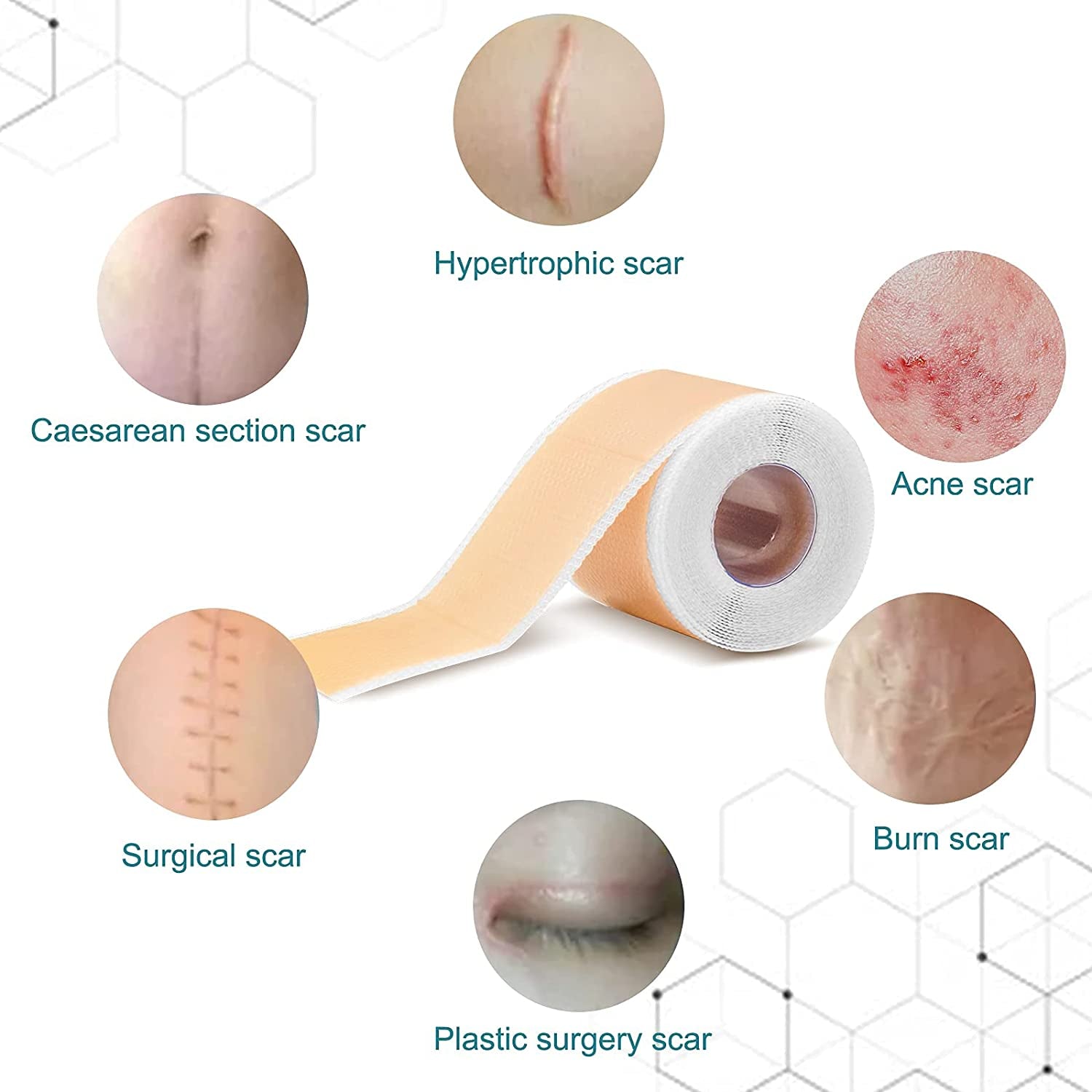 Silicone Scar Sheets,Scar Removal,Silicone Scar Tape Roll for C-Section,Professional Painless Silicone Keloid Scars from Surgery, Burn, Acne Et (1.6” X 60”Roll-1.5M)