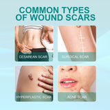 Fivfivgo Scarremove Advanced Scar Spray, 2023 New Scar Remove Spray for All Types of Scars, Surgical Scars and Stretch Marks, Especially Acne Scars (Size : 3Pc)